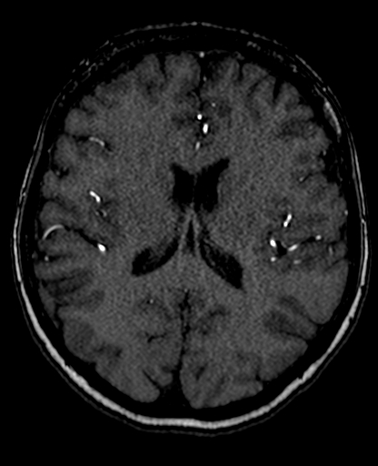 Berry aneurysm of the terminal internal carotid artery (Radiopaedia 88286-104918 Axial TOF 144).jpg