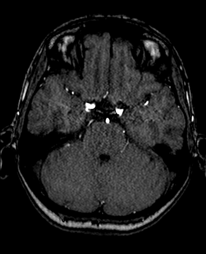 Berry aneurysm of the terminal internal carotid artery (Radiopaedia 88286-104918 Axial TOF 90).jpg