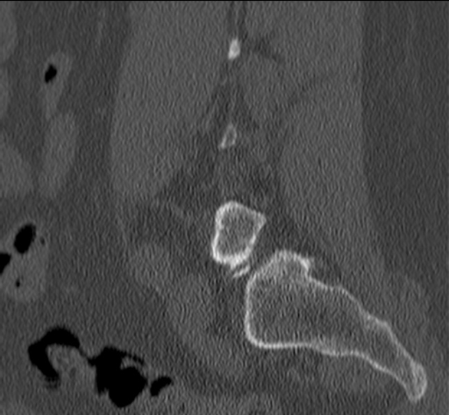 Bertolotti syndrome (Radiopaedia 24864-25128 Sagittal bone window 43).jpg