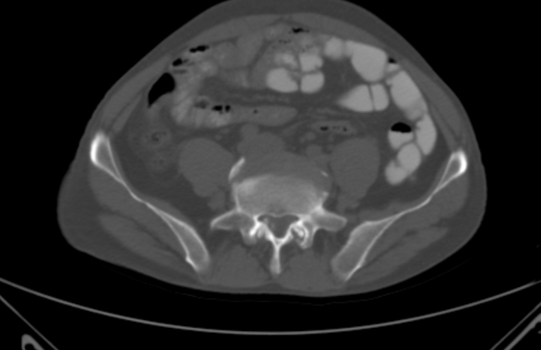 File:Bertolotti syndrome (Radiopaedia 58974-66235 Axial bone window 14).jpg