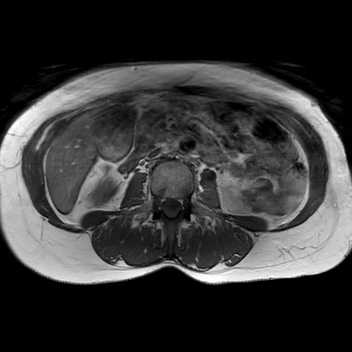 File:Bicornuate uterus (Radiopaedia 61974-70046 Axial T1 3).jpg