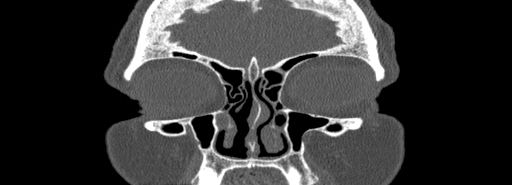 Bilateral Ectopic Infraorbital Nerves (Radiopaedia 49006-54084 Coronal bone window 11).jpg