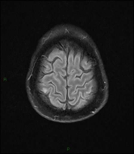 File:Bilateral acute middle cerebral artery territory infarcts (Radiopaedia 77319-89402 Axial FLAIR 21).jpg