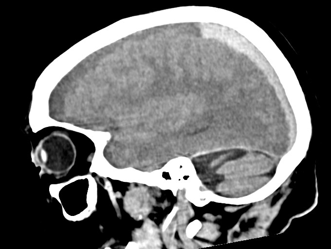 Bilateral acute on chronic subdural hematomas (Radiopaedia 78466-91146 C 20).jpg