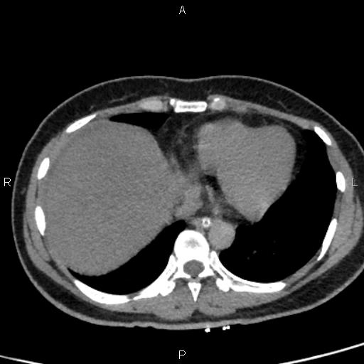 Bilateral adrenal gland hyperenhancement in pancreatitis (Radiopaedia 86642-102753 Axial non-contrast 7).jpg