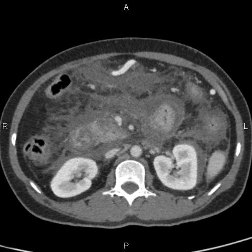 Bilateral adrenal gland hyperenhancement in pancreatitis (Radiopaedia 86642-102753 E 45).jpg