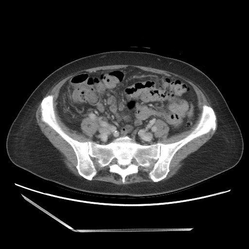 Bilateral adrenal granulocytic sarcomas (chloromas) (Radiopaedia 78375-91007 A 83).jpg
