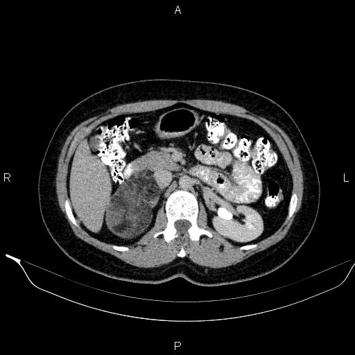 Bilateral adrenal myelolipoma (Radiopaedia 63058-71535 Axial C+ delayed 43).jpg