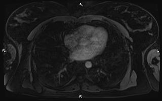 Bilateral adrenal myelolipoma (Radiopaedia 63058-71537 Axial T1 C+ fat sat 3).jpg