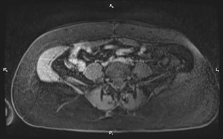 File:Bilateral adrenal myelolipoma (Radiopaedia 63058-71537 H 79).jpg