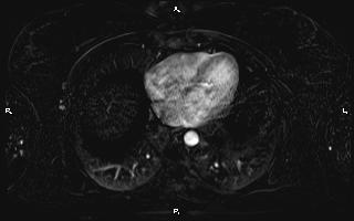 Bilateral adrenal myelolipoma (Radiopaedia 63058-71537 I 8).jpg