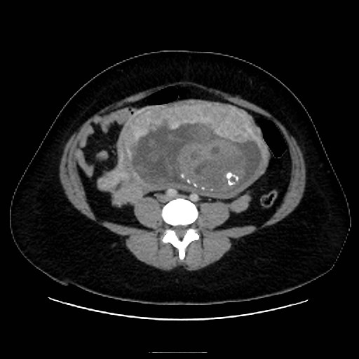 Bilateral adrenal thrombosis (Radiopaedia 58182-65256 A 47).jpg