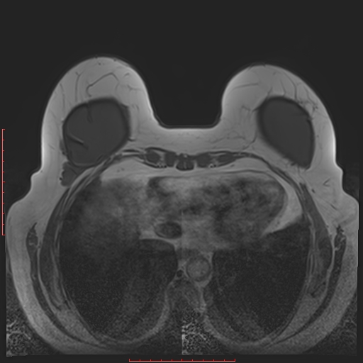 File:Bilateral breast implant rupture (Radiopaedia 24761-25027 T1 28).jpg