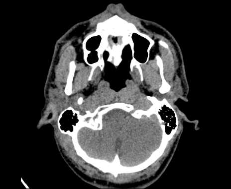 Bilateral carotid body tumors (Radiopaedia 61841-69870 Axial non-contrast 11).jpg