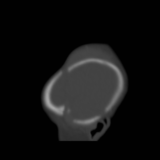 File:Bilateral cephalohematomas and subdural hematomas (Radiopaedia 26778-26929 Sagittal bone window 4).jpg
