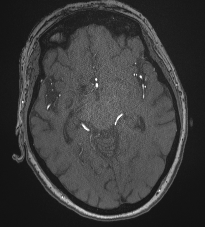 Bilateral fetal posterior communicating arteries (Radiopaedia 41286-44102 Axial MRA 94).png