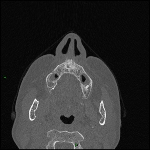 Bilateral frontal mucoceles (Radiopaedia 82352-96454 Axial bone window 234).jpg
