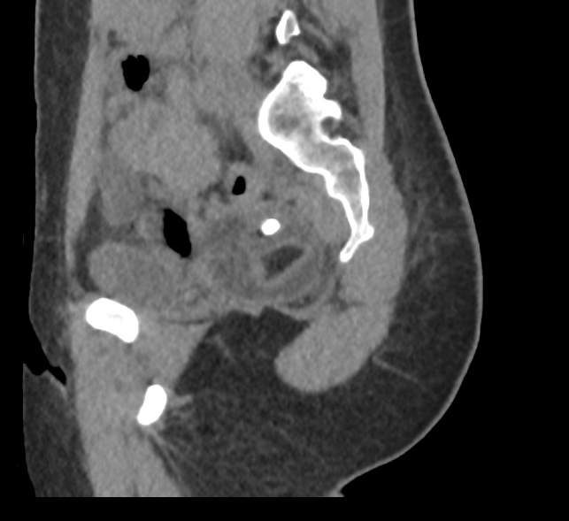 Bilateral mature cystic ovarian teratoma (Radiopaedia 88821-105592 D 49).jpg