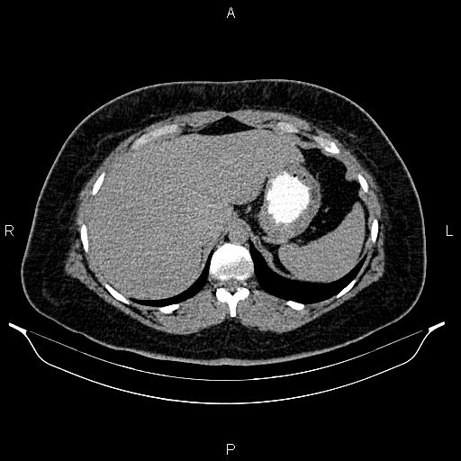 File:Bilateral ovarian dermoid cysts (Radiopaedia 85785-101603 Axial C+ delayed 8).jpg