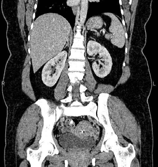 Bilateral ovarian dermoid cysts (Radiopaedia 85785-101603 C 37).jpg