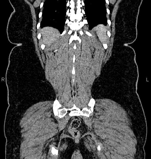 Bilateral ovarian dermoid cysts (Radiopaedia 85785-101603 C 53).jpg
