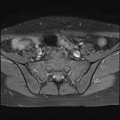 File:Bilateral ovarian endometriomas (Radiopaedia 87085-103347 Axial T1 C+ fat sat 3).jpg