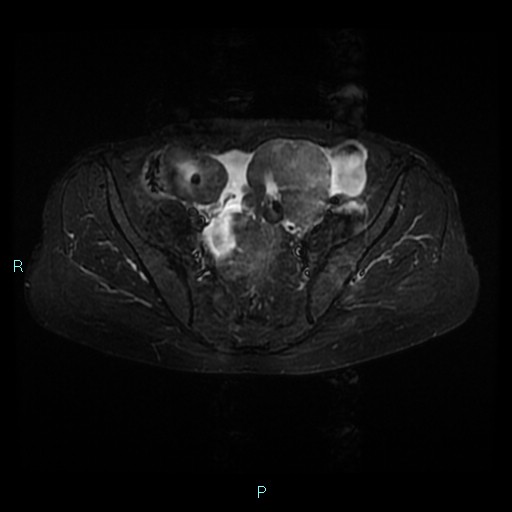 File:Bilateral ovarian fibroma (Radiopaedia 44568-48293 Axial STIR 10).jpg