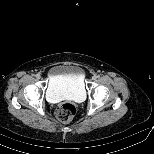 File:Bilateral ovarian serous cystadenocarcinoma (Radiopaedia 86062-101989 Axial C+ delayed 78).jpg