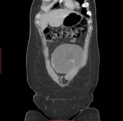 File:Bilateral ovarian serous cystadenocarcinoma with right ovarian torsion (Radiopaedia 32640-33611 B 4).jpg
