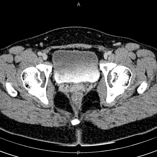 File:Bilateral ovarian teratoma (Radiopaedia 83131-97503 B 68).jpg
