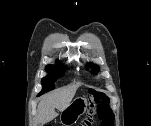Bilateral pulmonary AVM (Radiopaedia 83134-97505 C 11).jpg