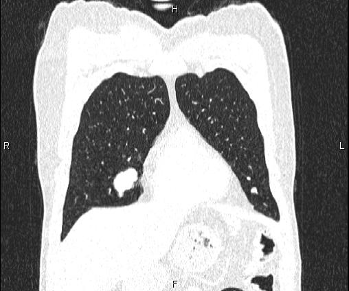 Bilateral pulmonary AVM (Radiopaedia 83134-97505 Coronal lung window 24).jpg