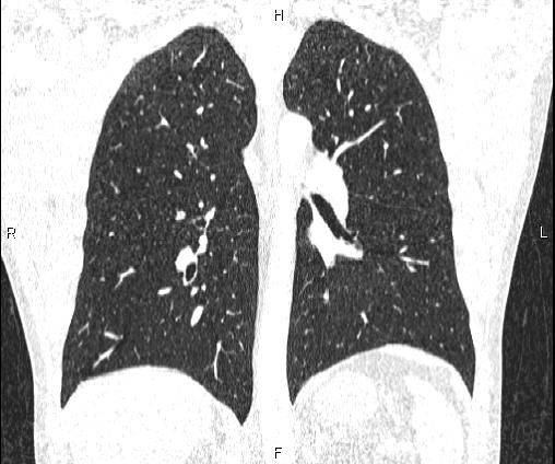 Bilateral pulmonary AVM (Radiopaedia 83134-97505 Coronal lung window 51).jpg