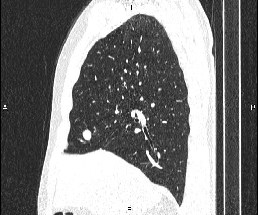 Bilateral pulmonary AVM (Radiopaedia 83134-97505 Sagittal lung window 43).jpg