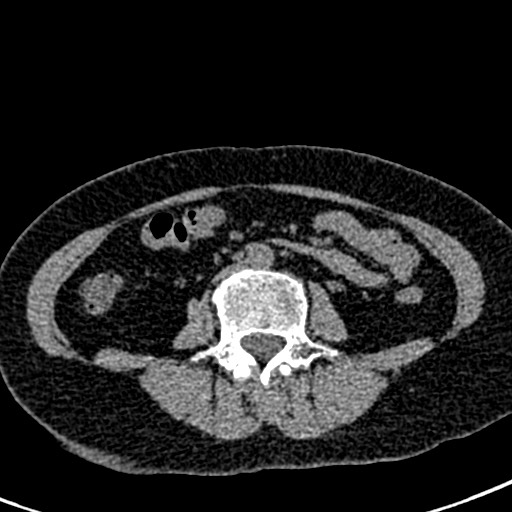 Bilateral staghorn calculi (Radiopaedia 59475-66842 Axial non-contrast 41).jpg