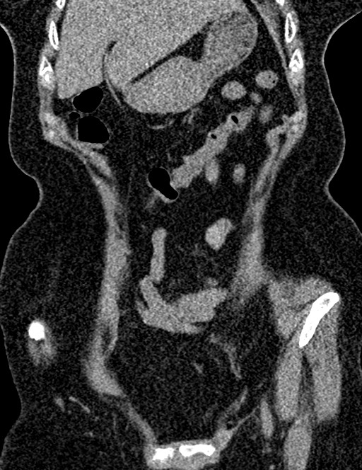 Bilateral staghorn calculi (Radiopaedia 59475-66842 Coronal non-contrast 42).jpg