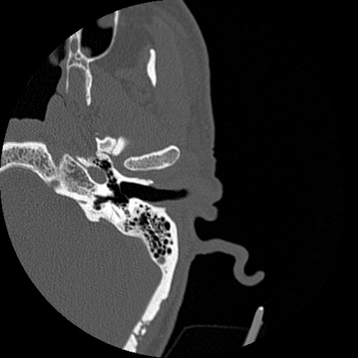 Bilateral temporal bone fractures (Radiopaedia 29482-29970 D 56).jpg