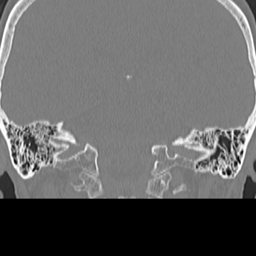 File:Bilateral tympanoplasty (Radiopaedia 16947-16664 Coronal bone window 24).jpg