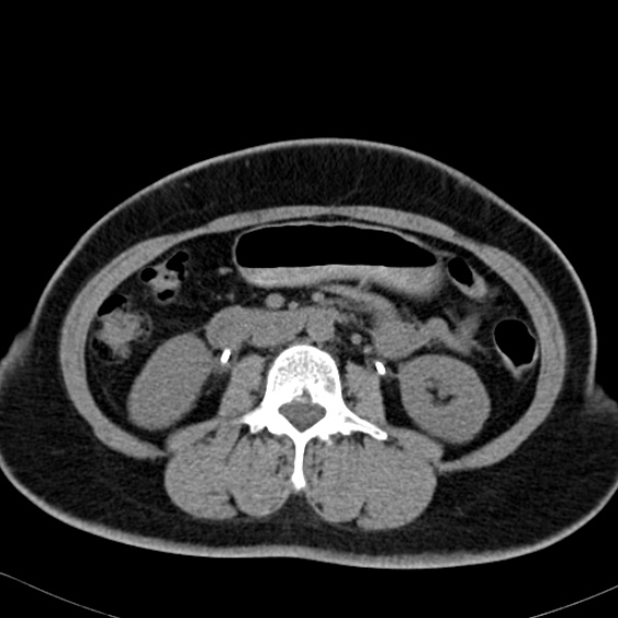 Bilateral ureteric stents (Radiopaedia 48795-53825 Axial non-contrast 28).jpg