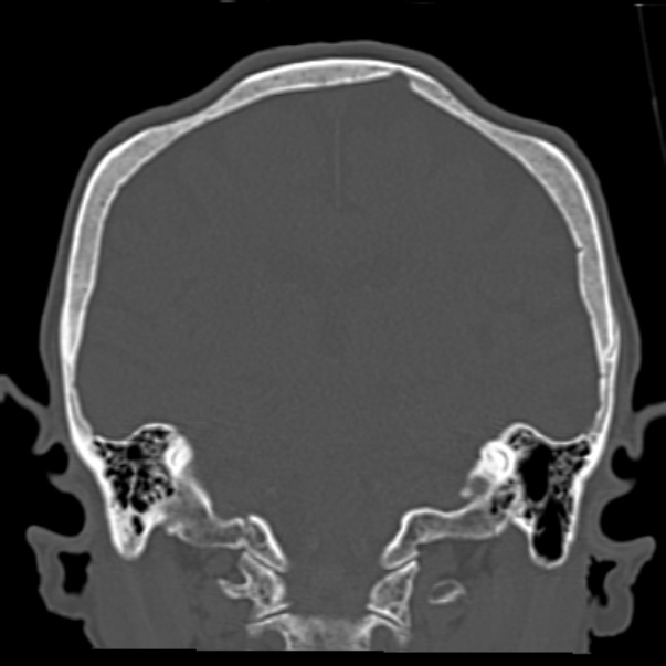 Biparietal osteodystrophy (Radiopaedia 46109-50463 Coronal bone window 66).jpg