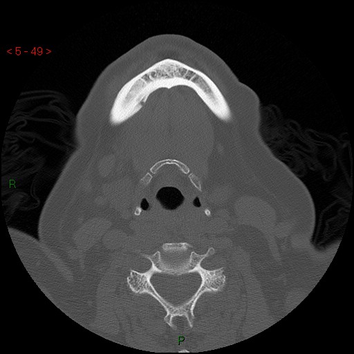 Bisphosphonate-related osteonecrosis of the jaw (Radiopaedia 54147-60329 Axial bone window 43).jpg