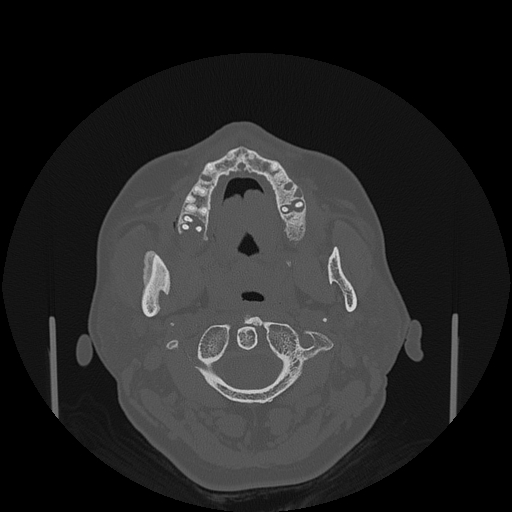 File:Bisphosphonate-related osteonecrosis of the jaw (Radiopaedia 71324-81642 Axial bone window 104).jpg