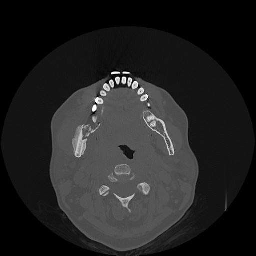 File:Bisphosphonate-related osteonecrosis of the jaw (Radiopaedia 71324-81642 Axial bone window 67).jpg