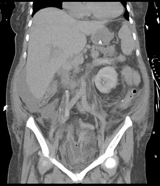 File:Bladder rupture post renal biopsy (Radiopaedia 30863-31572 Coronal non-contrast 30).jpg