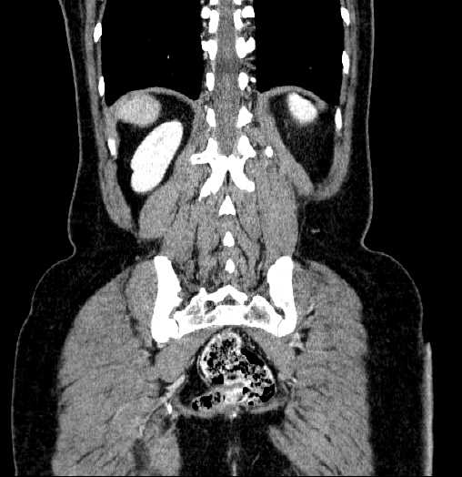Blind-ending branch of a bifid ureter (Radiopaedia 61159-69048 C 58).jpg