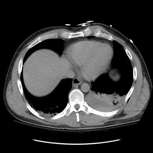 Blunt abdominal trauma with solid organ and musculoskelatal injury with active extravasation (Radiopaedia 68364-77895 Axial C+ delayed 14).jpg