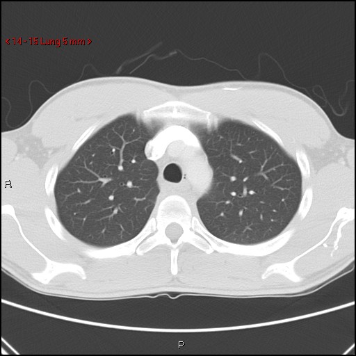 Blunt chest trauma - pulmonary interstitial emphysema and pneumomediastinum (Radiopaedia 20666-20552 Axial lung window 15).jpg