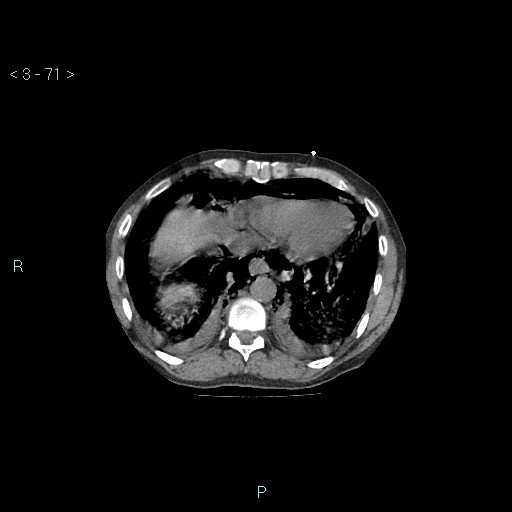 Boerhaave syndrome (Radiopaedia 27683-27897 Axial non-contrast 71).jpg