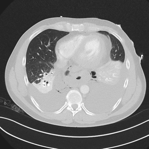 Boerhaave syndrome (Radiopaedia 39382-41660 Axial lung window 38).png