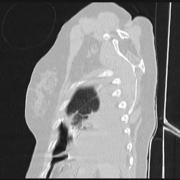 Boerhaave syndrome (Radiopaedia 45644-49799 Sagittal lung window 77).jpg